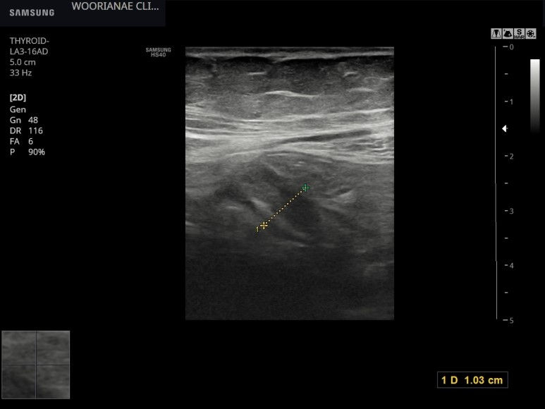 설사없는 하복부 통증, 우하복부 압통 및 반발압통 (rebound tenderness), 초음파로 충수돌기염 확인