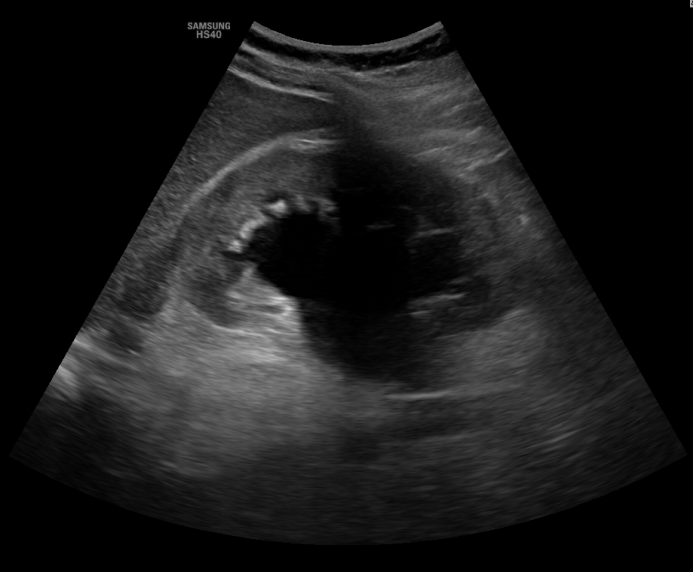 복부, 신장 초음파 - 뇌경색 환자 경동맥 평가, 우연히 발견된 이첨판 협착 (mitral stenosis), 무증상 세균뇨로 생각하였으나 발열 생기고 초음파상 일측 수신증