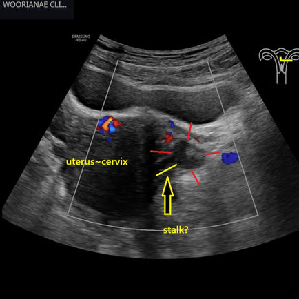 자궁옆 낭종? 종괴?? 리뷰시 줄기가 보여 장막하 근종 가능성; 복부 평가시 발견되는 골반 병변들 - 동대문구 답십리, 중곡동, 우리안애 우리안愛 내과