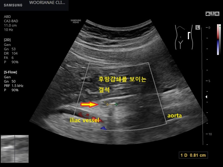 복부, 신장 초음파; 1주일전, 그리고 내원일 발생한 1~2시간 지속되는 옆구리 및 좌하복부 통증, 장골혈관 상부 근위부 요로결석