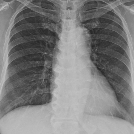 후비루에 의한 기침의 배경에서 발생한 발한? 폐렴을 소견/증거는 없어 증상적 투약 후 추적 - 동대문구 답십리, 전농동, 우리안애 우리안愛 내과