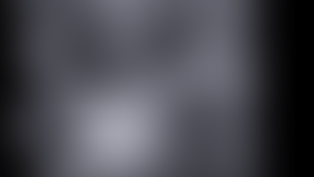 갑상선 초음파; 인지하지 못했으나, 촉지되고 관찰되는 목의 결절로 내원하여 갑상선 세침검사 시행 - 갑상선 유두암