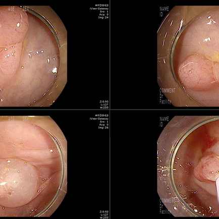 다수의 진행성 대장 선종의 추적 검사, 헬리코박터 제균된 위내시경 모습의 확인 - 동대문구 답십리, 전농동, 우리안애 우리안愛 내과