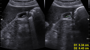 복부, 담낭초음파; 과거부터 반복되는 간헐적 수시간 지속되는 경련성 복통을 주소로 내원, 담석 증상으로 판단하였고 초음파상 담석 확인하여 증상의 인과관계를 판단함