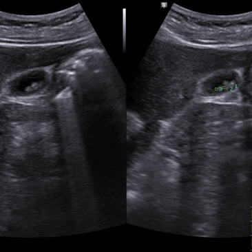 복부, 담낭초음파; 과거부터 반복되는 간헐적 수시간 지속되는 경련성 복통을 주소로 내원, 담석 증상으로 판단하였고 초음파상 담석 확인하여 증상의 인과관계를 판단함