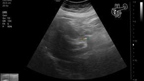 담낭 절제 배경에서 우상복부 통증, 총담관석 - 동대문구 답십리, 행당동, 우리안애 우리안愛 내과