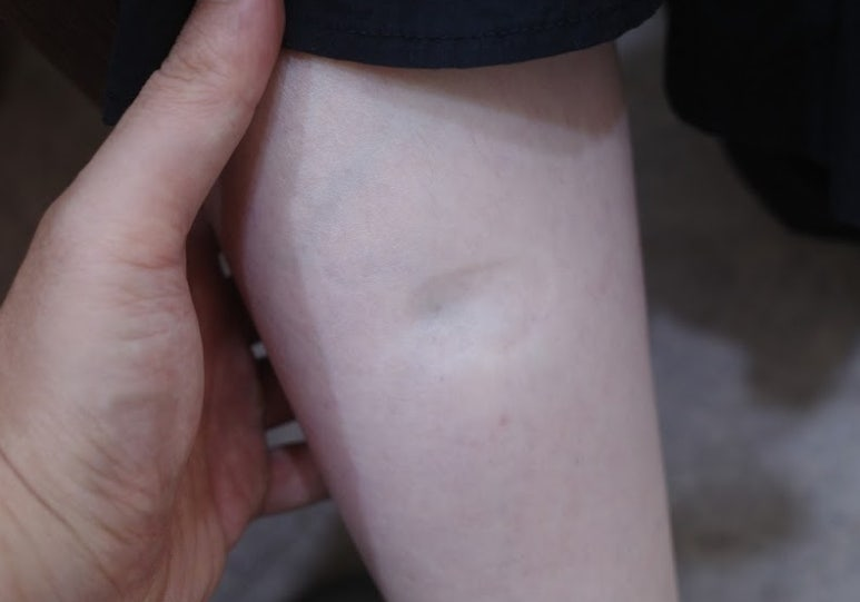 다리 부종? 다수의 가능성 중 답을 찾을수 있을것인가?; TSH 10~20 사이에서도 이 정도의 증상의 경험 - 동대문구 답십리, 전농동, 우리안애 우리안愛 내과