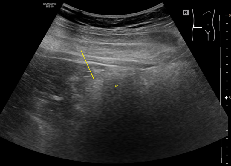 미리 얘기하지 않으면 스무고개 같은 진료, 게실염의 불완전 치료의 모습, 그리고도 멋대로 추적 소실 - 동대문구 답십리, 전농동, 우리안애 우리안愛 내과