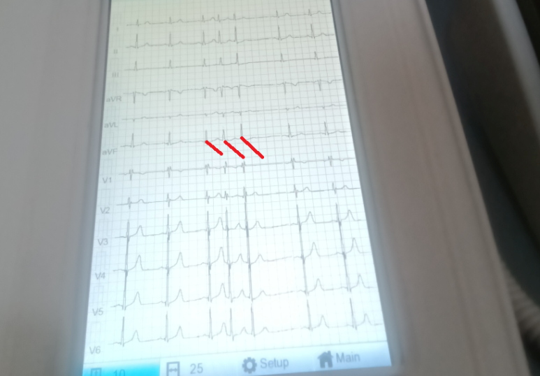 특직정이지 않은 흉통 기술의 확인, 협심증은 아니라 보아 약제 중단 후 추적, 부정맥은 기외수축 이상의? 평가가 필요 - 동대문구 답십리, 용답동, 우리안애 우리안愛 내과