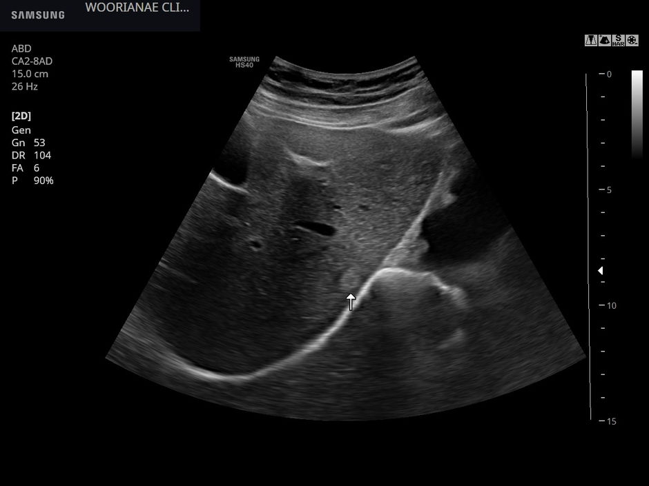 근래 시행한 검진, 다른 검진센터에서 언급이 없는 간결절의 발견 - 동대문구 답십리, 전농동, 우리안애 우리안愛 내과