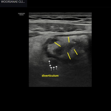 과거 게실염 입원력 환자의 복통, 초음파를 통한 게실염 확인 - 동대문구 답십리, 전농동, 우리안애 우리안愛 내과