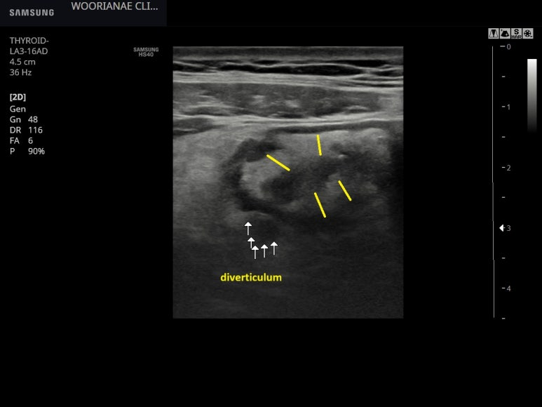 과거 게실염 입원력 환자의 복통, 초음파를 통한 게실염 확인 - 동대문구 답십리, 전농동, 우리안애 우리안愛 내과