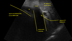 이행의 개념으로서 진행한 섬유화~간경화.. CT판독자는?.. 수년사이 초음파 변화가 뚜렷했던 경우의 상급병원 진료 (2) - 동대문구 답십리, 전농동, 우리안애 우리안愛 내과