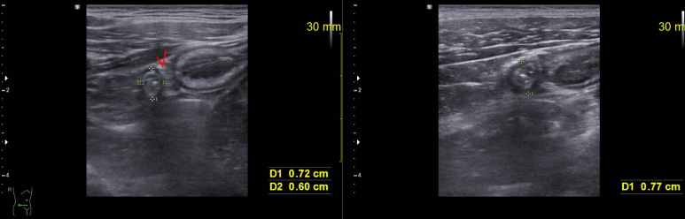 복부, 충수돌기 초음파; retrocecal appendicitis, 대장 뒤쪽으로 위치하는 충수돌기의 충수돌기염
