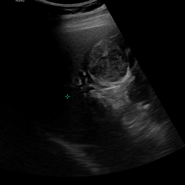 복부, 간초음파; 혈변과 1주일간의 설사; 간전이를 동반한 직장암