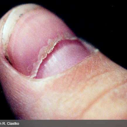 수족구 이후 발톱 10개가 다 빠졌었다? 에 대한 내용확인 - 동대문구 답십리, 전농동, 우리안애 우리안愛 내과