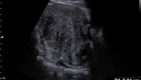 하복부, 골반 초음파; 자궁선근증, 반복되는 빈혈과 방광 압박증상