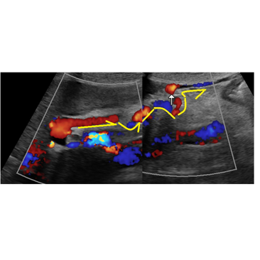 재개통된 제대정맥, 정맥관인대열을 통해 좌문맥의 제대부와 연결되는 모습, 흐름은 간에서 배꼽으로 - 동대문구 답십리, 전농동, 우리안애 우리안愛 내과