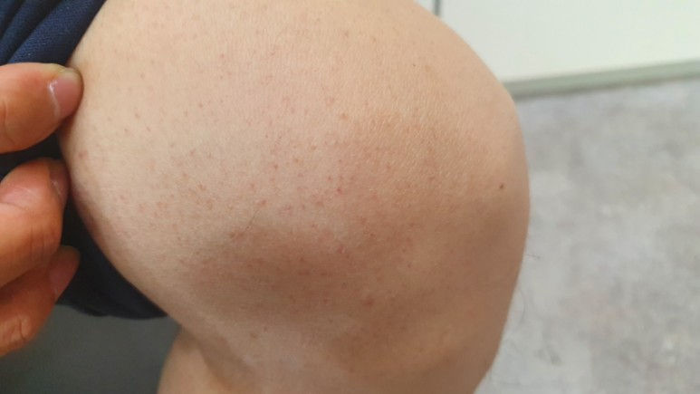 2번의 이벤트로서의 장염? 다른 질환 가능성? 약 10 kg의 체중감소, 피부의 자반? CT 조영제의 지연성 과민반응 고려 - 동대문구 답십리, 전농동, 우리안애 우리안愛 내과