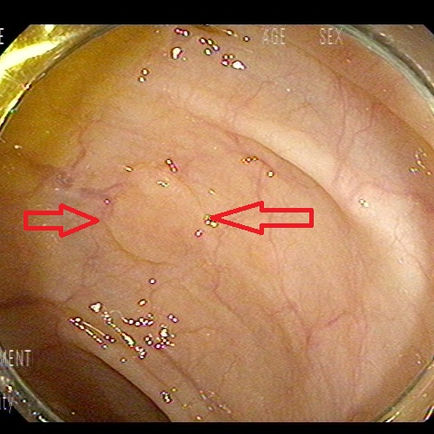 70대 대장내시경에서 육안적으로 거치상 용종의 확인 및 제거, 조직검사 결과 확인 필요 - 동대문구 답십리, 전농동, 우리안애 우리안愛 내과