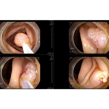과거 용종절제 후 제자리 암종이었던 경우, 다른 증상으로 내원시 추적여부의 확인 - 동대문구 답십리, 전농동, 우리안애 우리안愛 내과