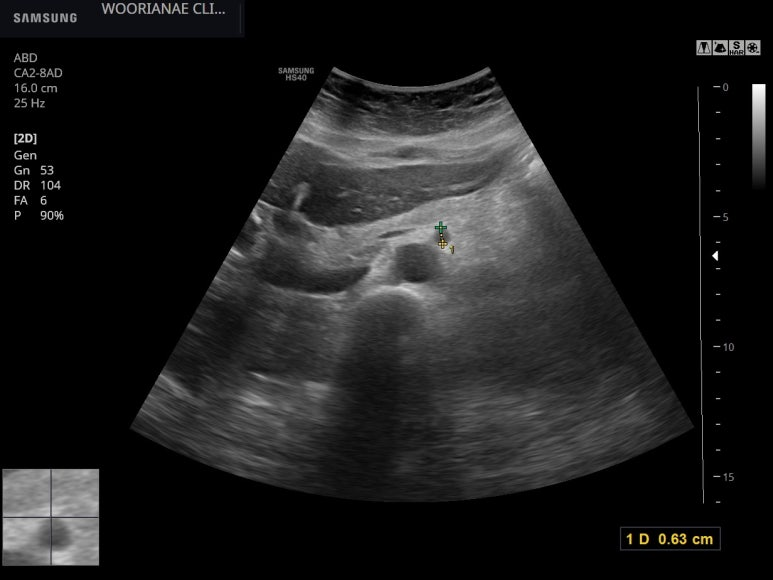 (환자가) 화가 냈던? (2); 타의원 초음파시 얼버무리니... 상장간막동맥을 췌장 종괴로 기술한 듯  - 동대문구 답십리, 전농동, 우리안애 우리안愛 내과