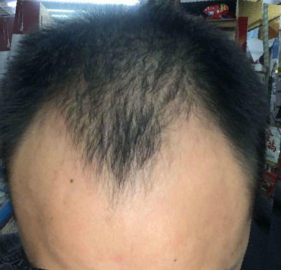 重度脫髮