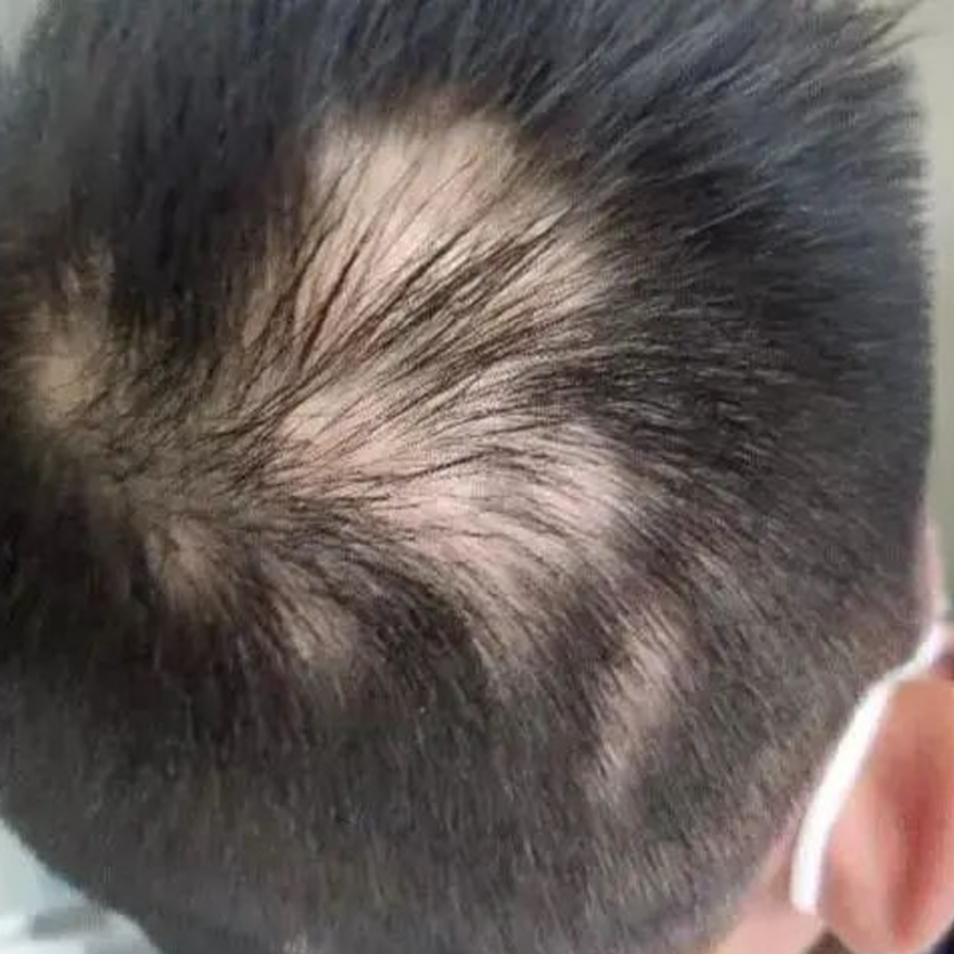 鬼剃頭類型, 多發性鬼剃頭