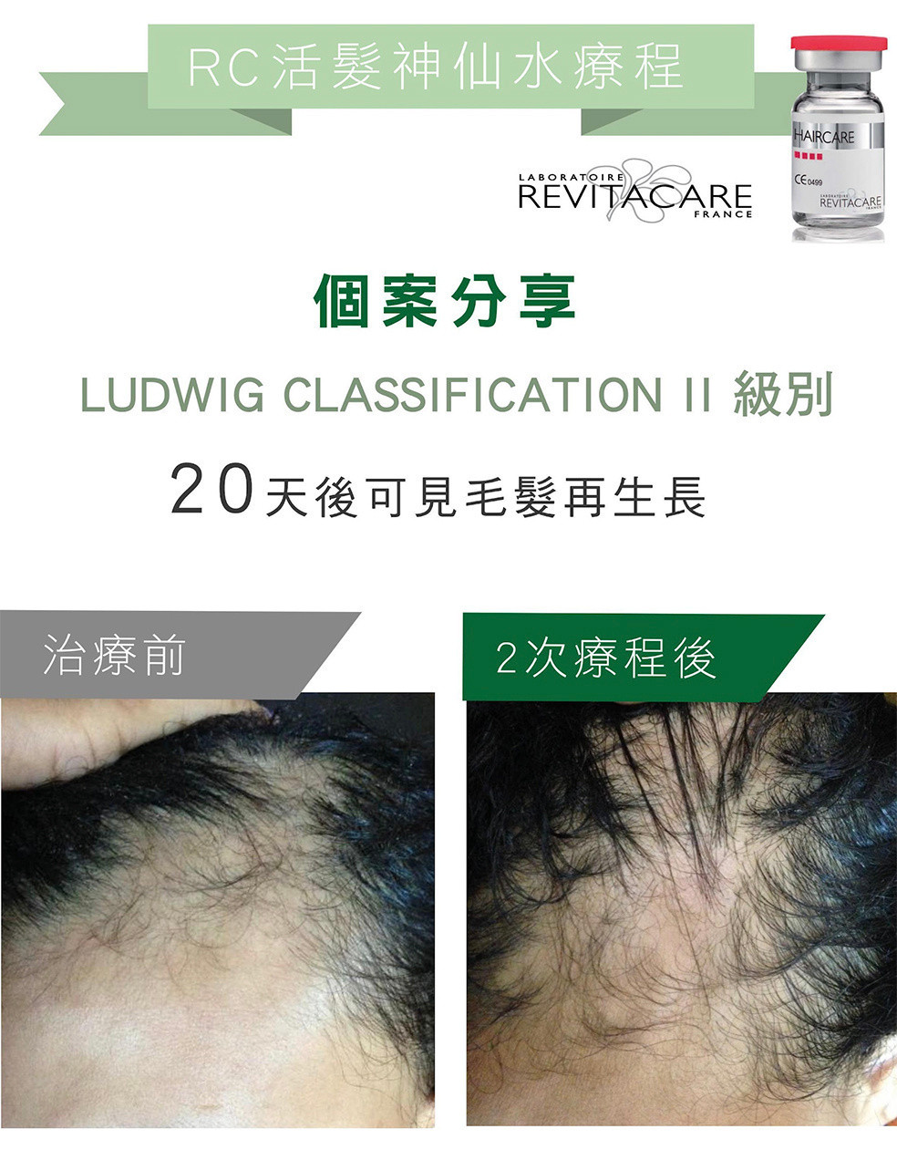 活髮療程效果