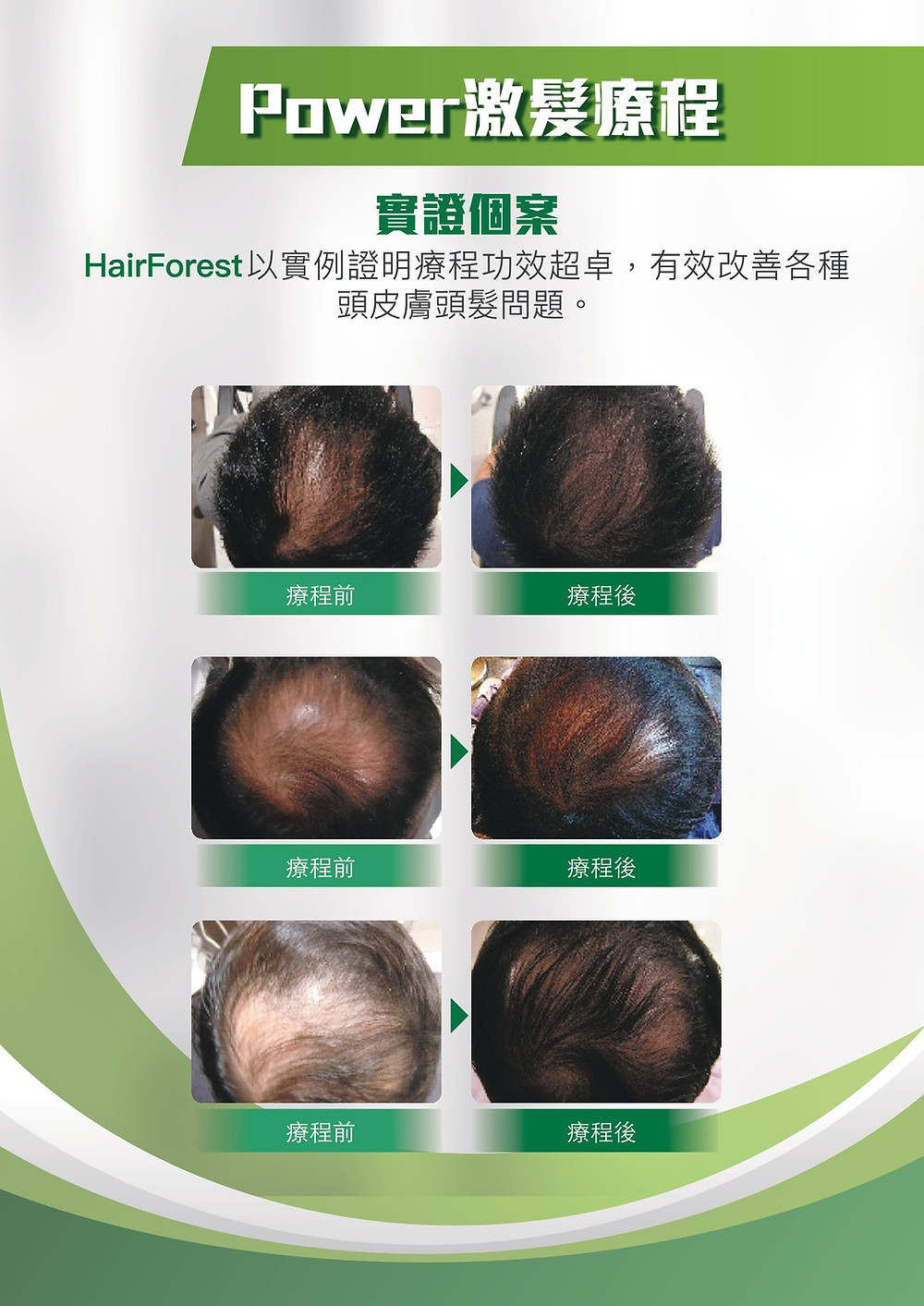 激髮療程效果