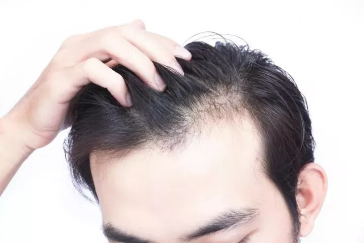 雄禿