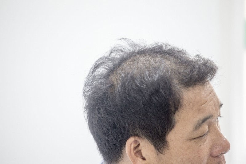 雄激素性脫髮