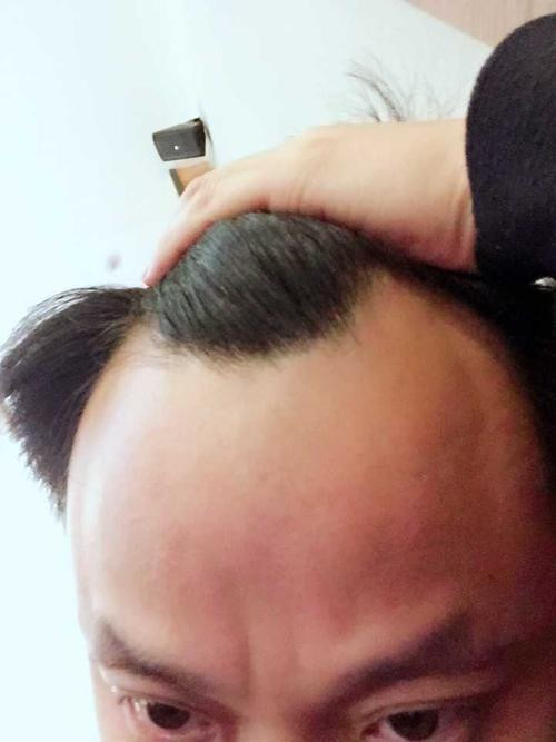 髮線向後移自我檢查