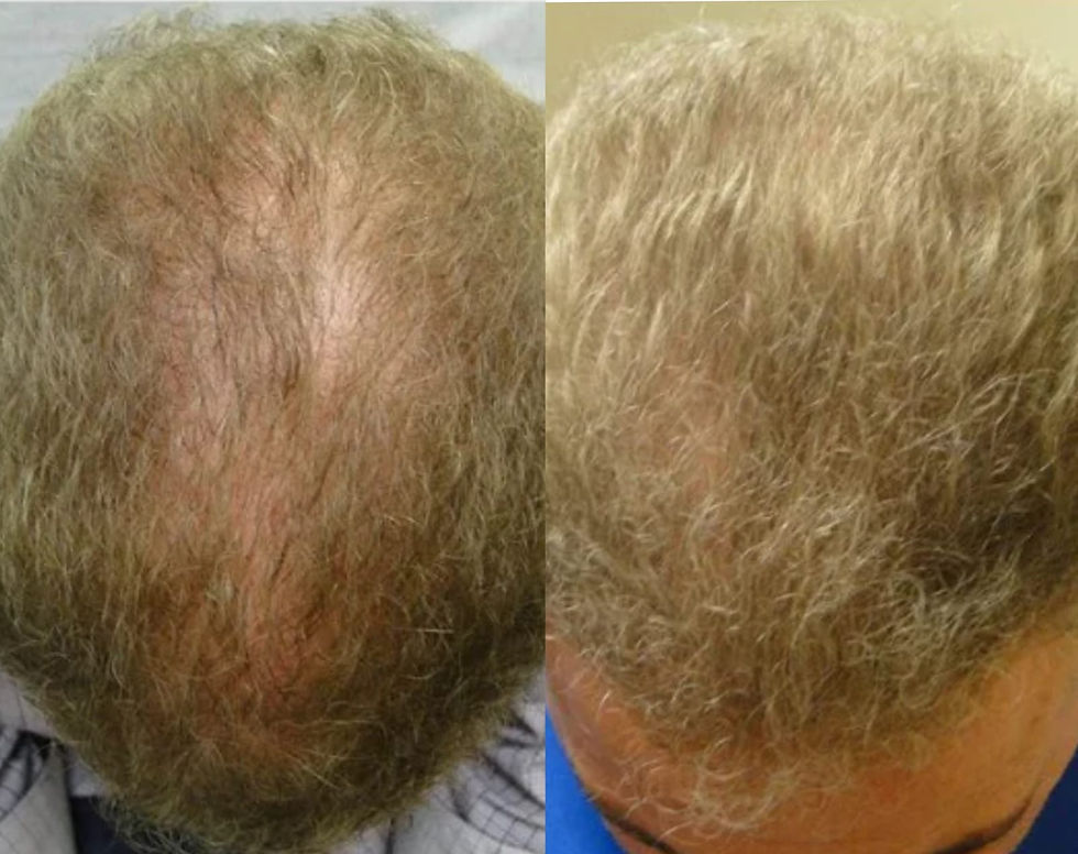 Thumbnail: Lustrao Hair Regrowth Oil