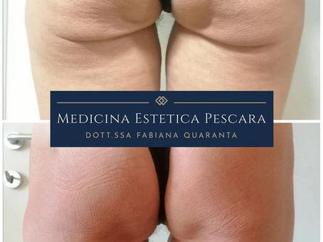 Acido Polilattico per rimodellamento dei glutei