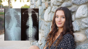 Scoliosis Changed My Life for the Better