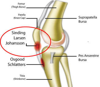 Fixing Patellar Tendon Pain