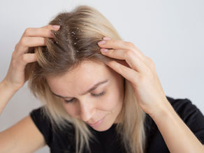 a woman with dandruff in her hair