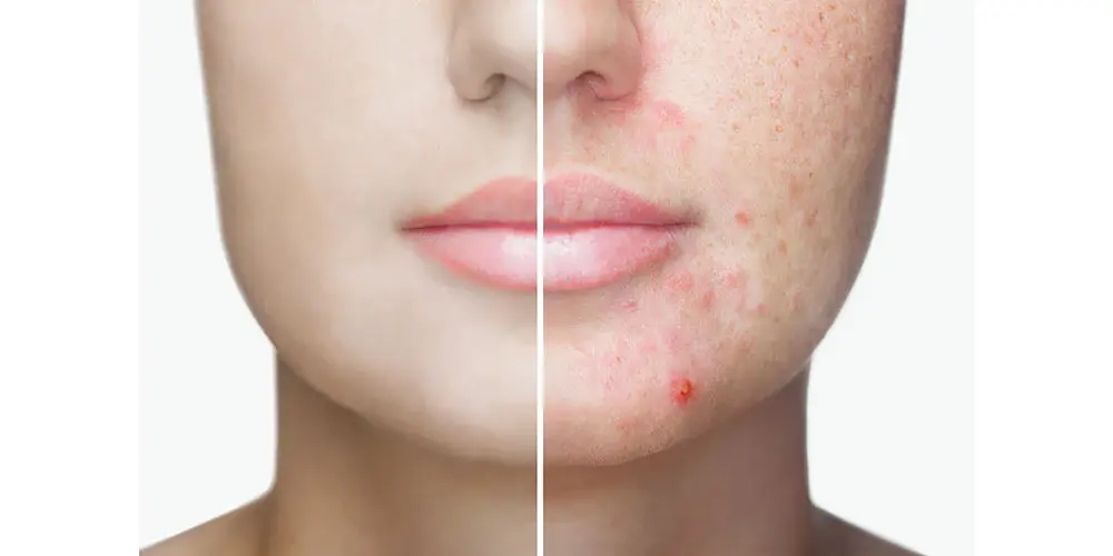 Glycolic Acid and Hypochlorous Acid