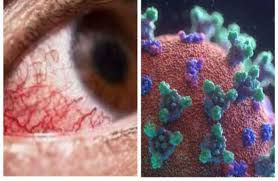 Virus expert reveals causes of infection with Black Fungus, symptoms, reasons for spread