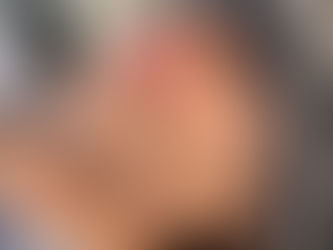 10月：before after@大阪梅田メンズ脱毛サロン｜メンズ堂々