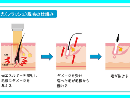 なぜ毛はなくなるのか?【意外と知らない脱毛の原理】徹底解説!! @大阪メンズ脱毛サロン|メンズ堂々