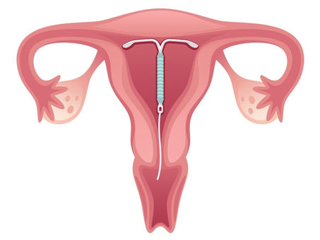 O DIU aumenta o fluxo menstrual?