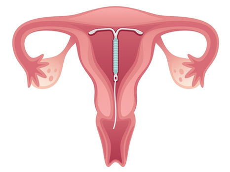 O DIU aumenta o fluxo menstrual?