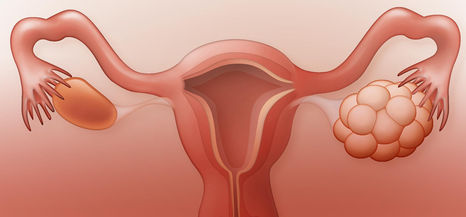 Alterações menstruais X Ovário Policístico