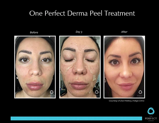 oneperfectdermapeel.webp