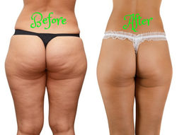 Beautiful Image Co. Butt Lift
