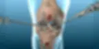 Knee-Arthoscopy.jpg.webp