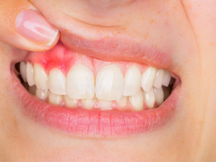 The Connection Between Diabetes and Oral Health