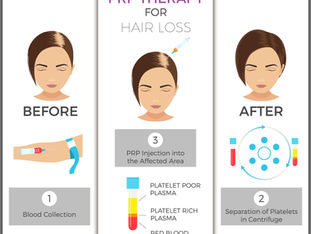 PRP – Hair Loss Treatment Blog